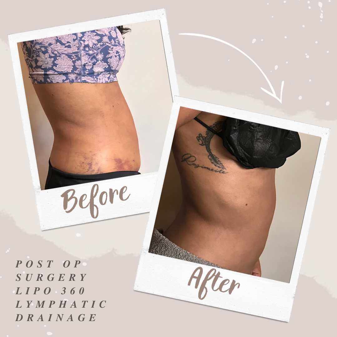 Lipo 360; Liposuction 360 post op surgery Lymphatic Drainage massage