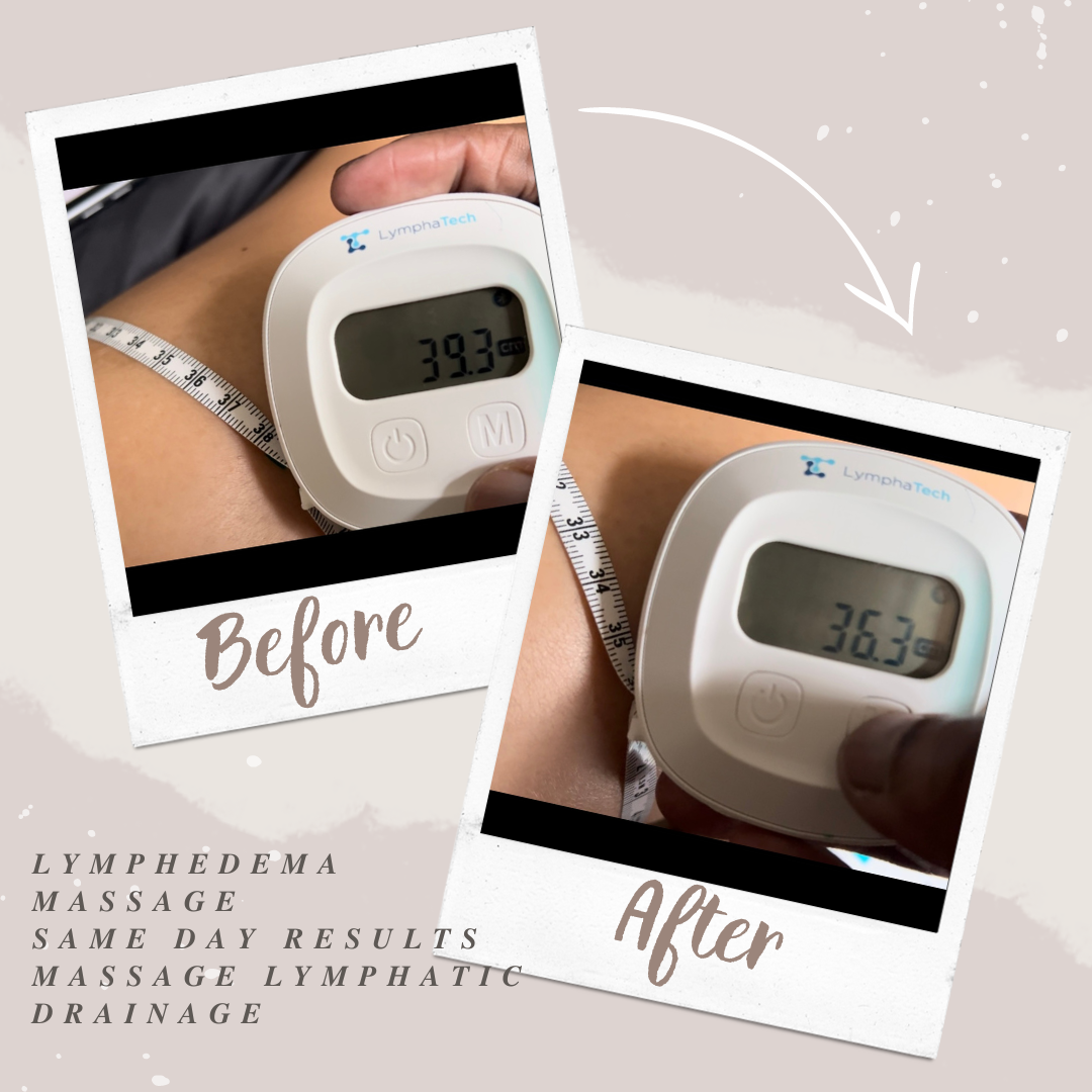 Lymphedema MLD Lymphatic Drainage Massage 