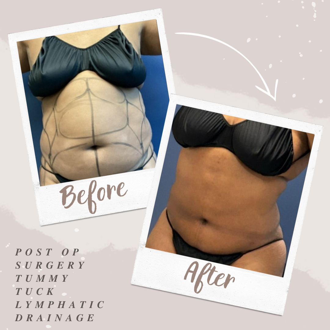 Tummy Tuck; Lipo; BBL ; Post Op Surgery; Lymphatic Drainage massage