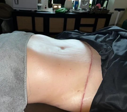 After post-op tummy tuck surgery lymphatic drainage Woodbridge VA
