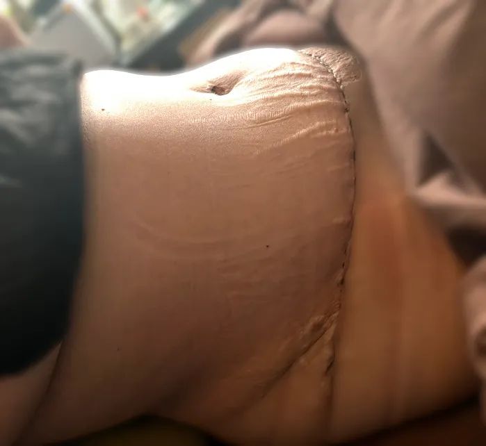 Brazilian lymphatic drainage massage before results Woodbridge VA